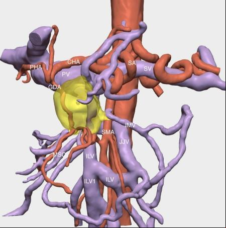 Un tumor de páncreas adherido a ramificaciones venosas
