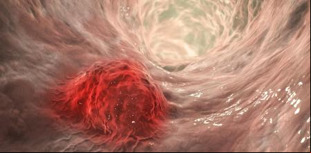 Una nueva terapia duplica la supervivencia en el cáncer de colon de peor pronóstico