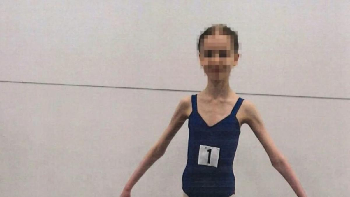 Cárcel para los padres que privaron de comida a su hija bailarina de 17 años, que pesaba como una niña de 9
